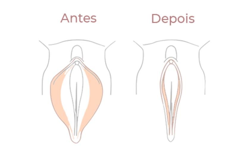 Dr. Octávio Curi Frascareli: Mitos e Verdades sobre a Ninfoplastia